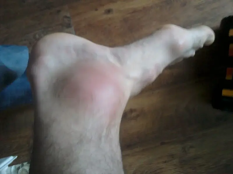 Ankle.webp