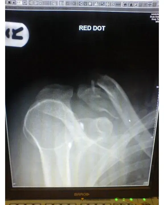 collar_bone_break.webp