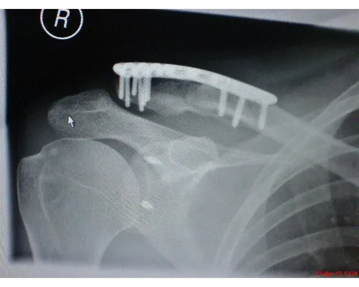 Shoulder_Fixed.webp