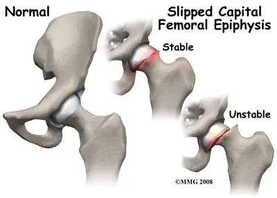 Slipped Caporal Femoral Epiphysis.webp