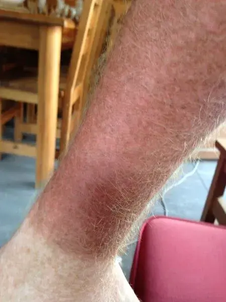 sunburn.webp