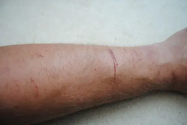 self harm.webp