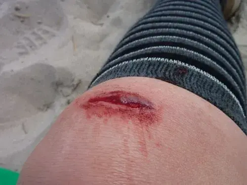 wound.webp