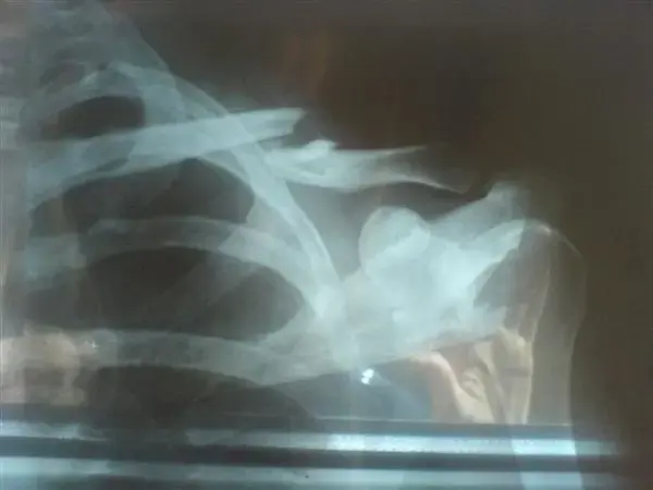 Collar bone.webp