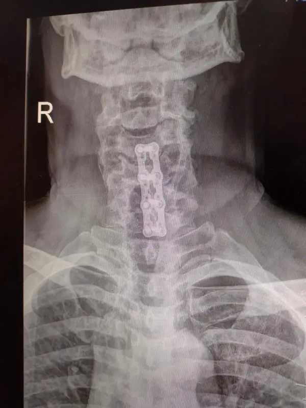 Jeff Spinal Fusion 12-7-2022 (3).webp
