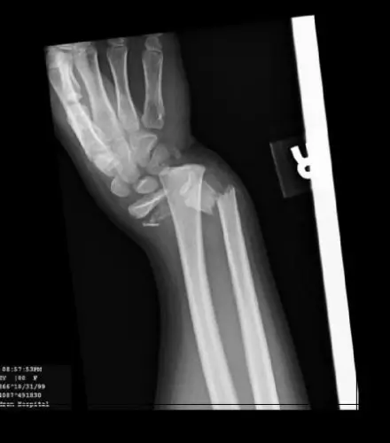 broken-wrist [1600x1200].webp