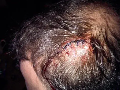 stitches.webp