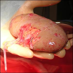 kidney.jpg